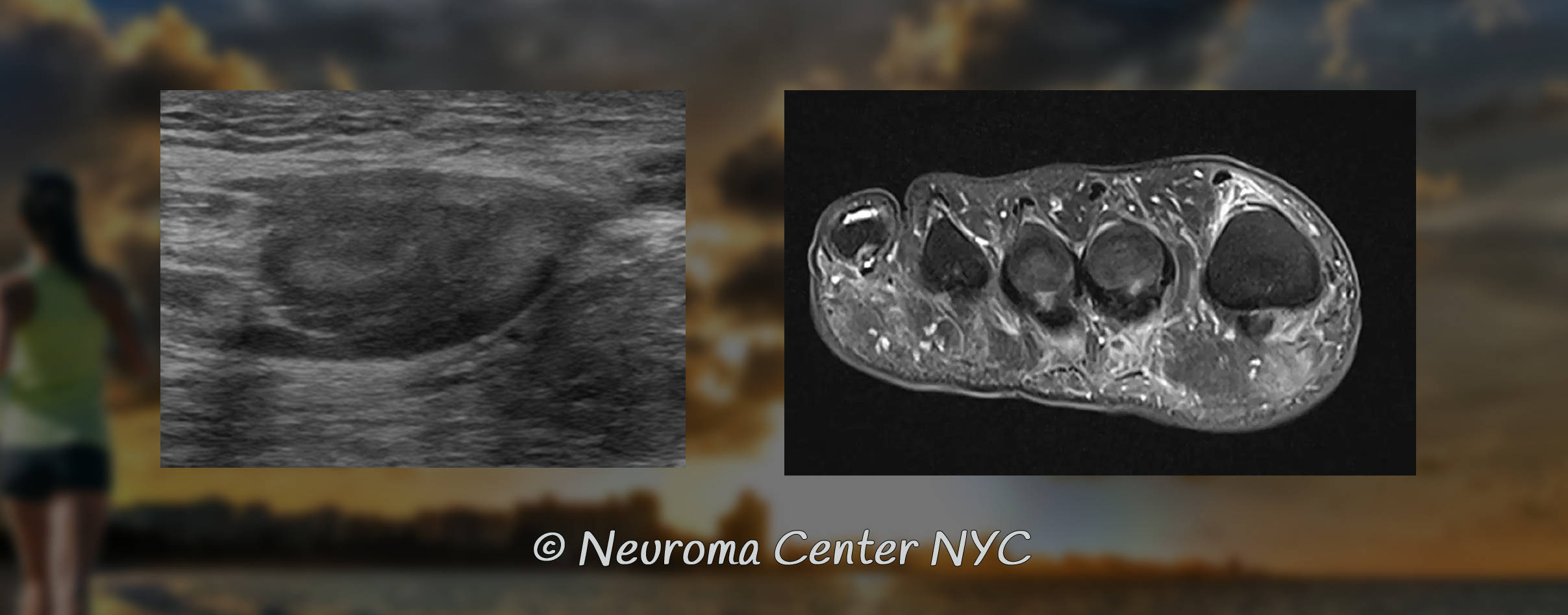 How do we diagnose neuromas p01